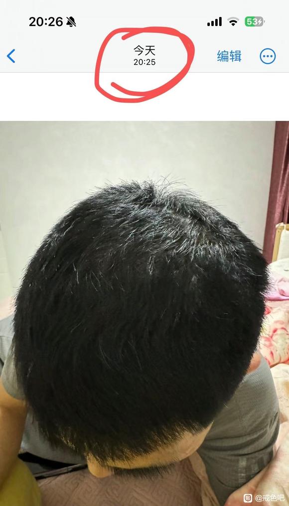 ”之前手yz造成的脱发终于治好了