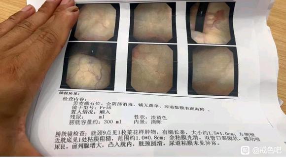 ”【戒友师兄投稿】邪yin30年致膀胱癌，戒色行善能救他吗？