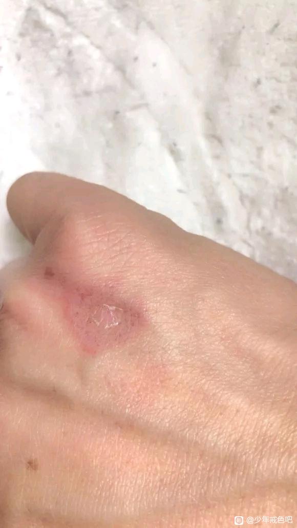 ”分享：寻花问柳得上病，苦不堪言！