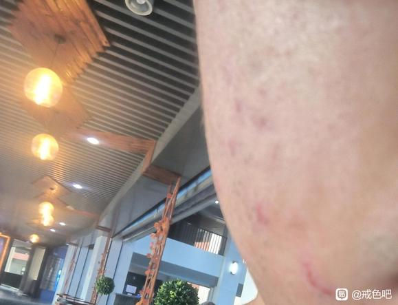 ”脸上痘一直消不掉